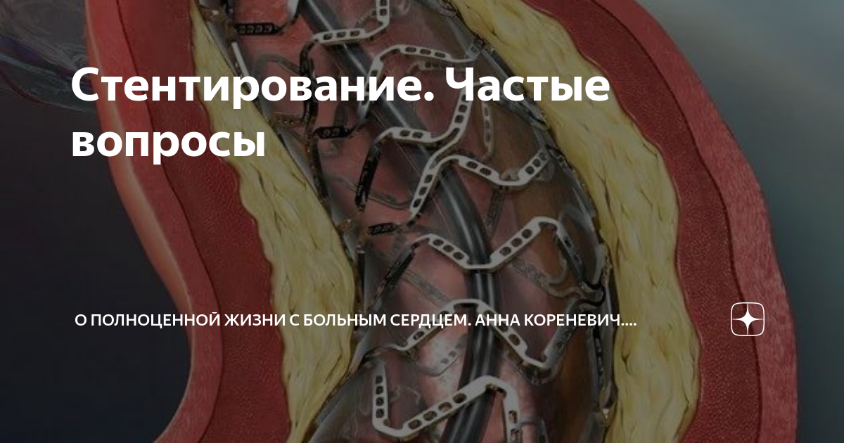 Инвалидность после инфаркта миокарда. Группа инвалидности при инфаркте. Стентирование сонной артерии операция. После стентирование сосудов сердца дают инвалидность. Стентирование нижних конечностей.