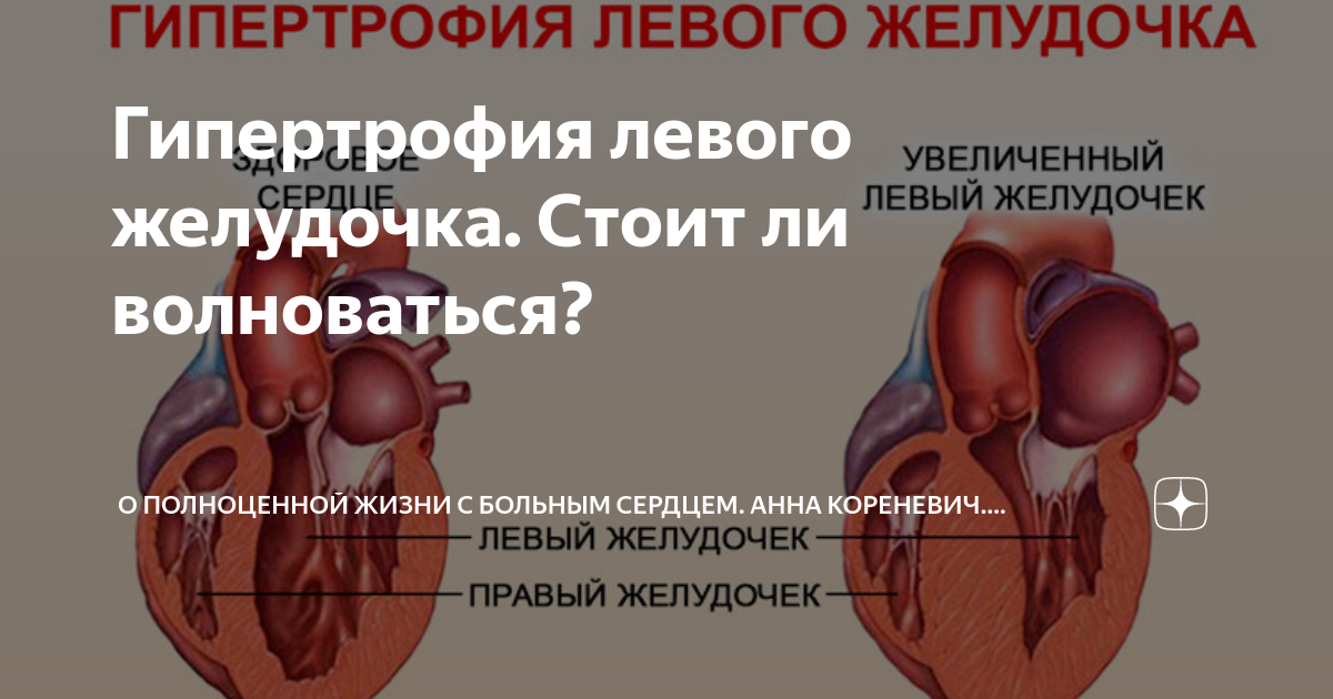 Гипертрофия левого желудочка: симптомы и диагностика в Киеве