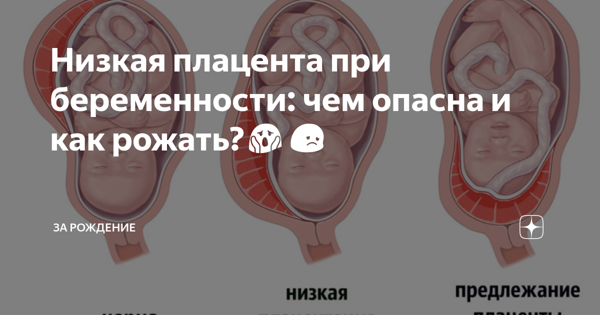 Низкая плацента при беременности: чем опасна и как рожать?