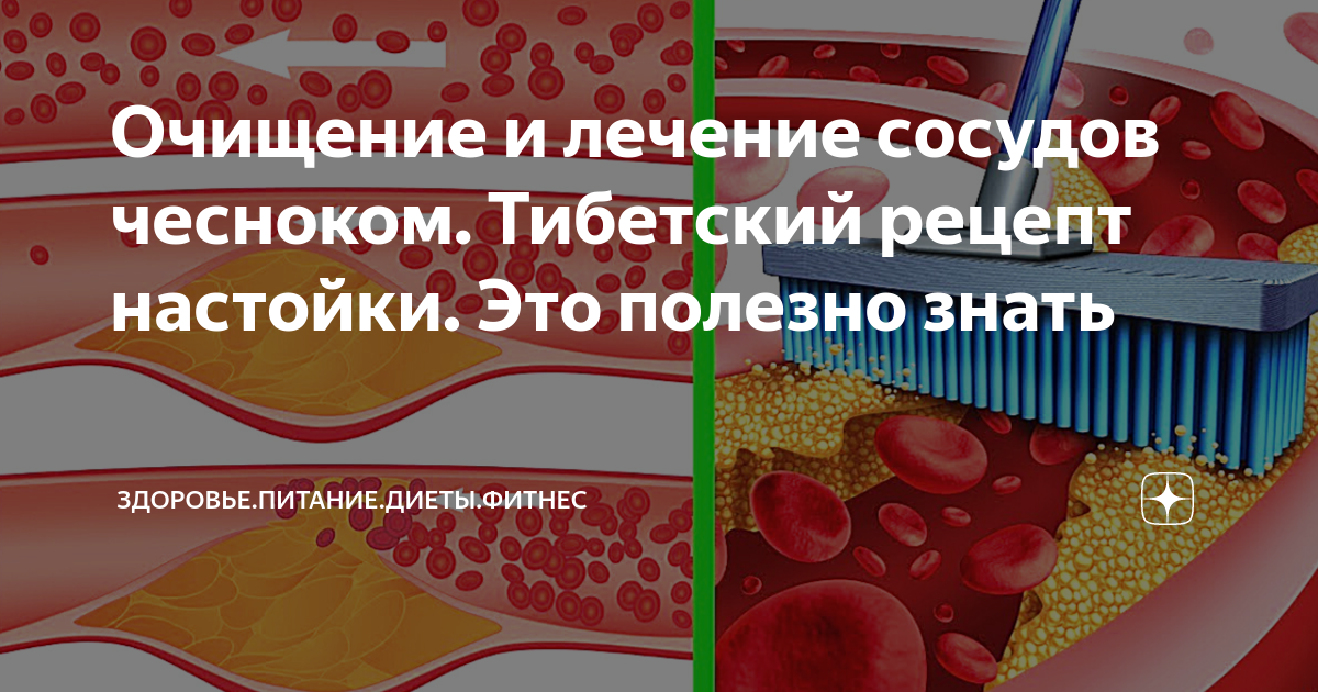 Рецепты чесночной настойка на спирте, самогоне, водке в домашних условиях