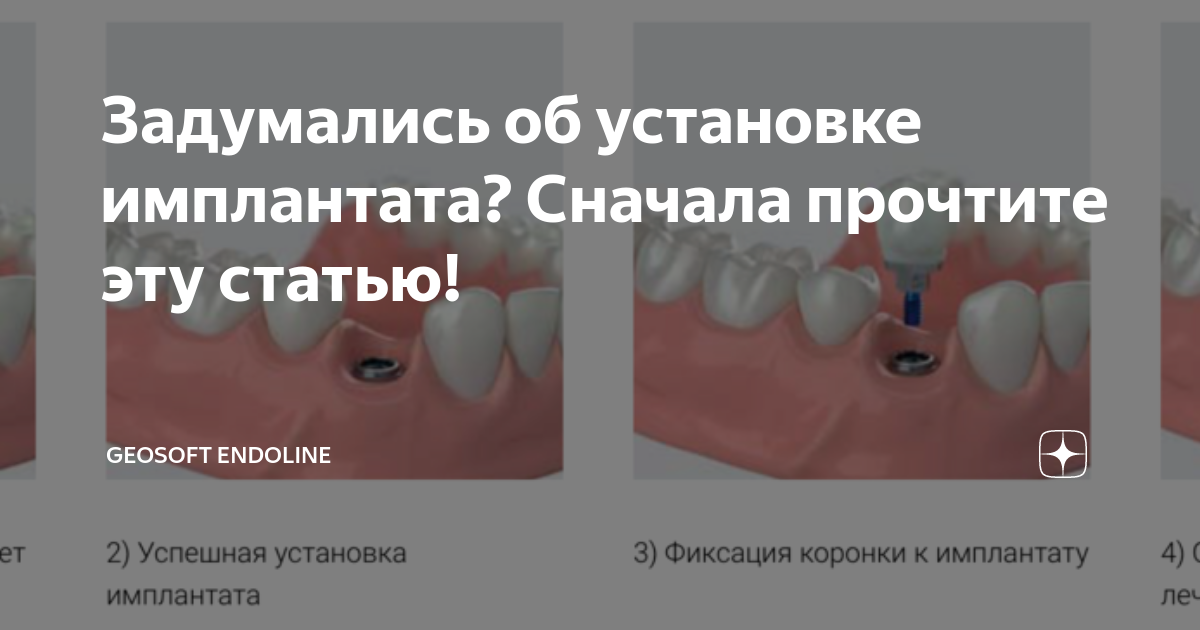 Установка импланта зуба отзывы пациентов. Ощущение после установки импланта зуба. Имплант болит после установки. Боль после установки абатмента. Болит ли после вживления импланта.