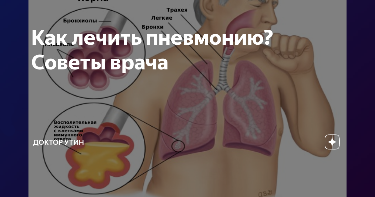 Как лечить пневмонию? Советы врача | Доктор Утин, кардиопоэт | Дзен