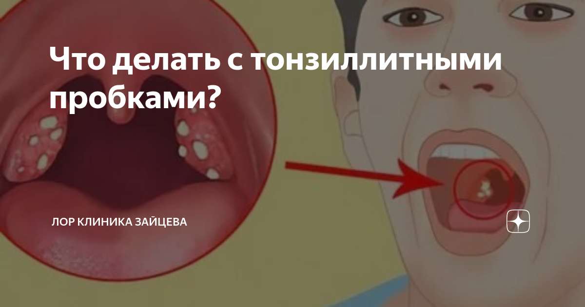 Что делать с тонзиллитными пробками? | ЛОР КЛИНИКА ЗАЙЦЕВА | Дзен