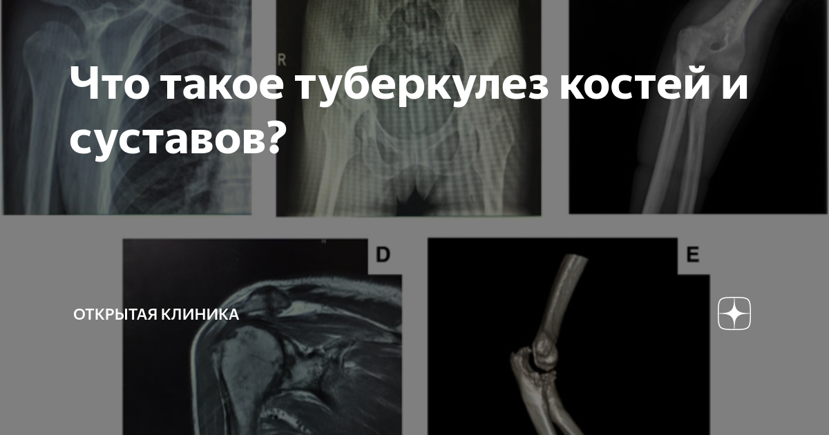 что такое туберкулез