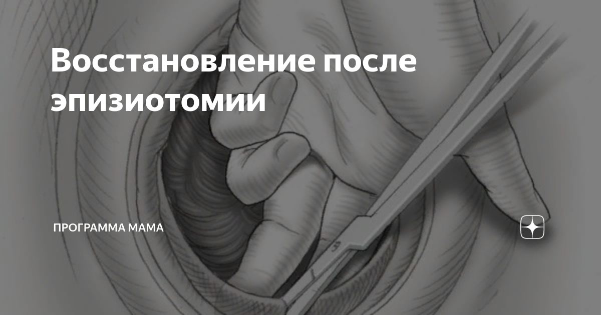 Как выглядит шов после эпизиотомии РОДОВОЙ ТРАВМАТИЗМ МАТЕРИ И ПЛОДА План лекции