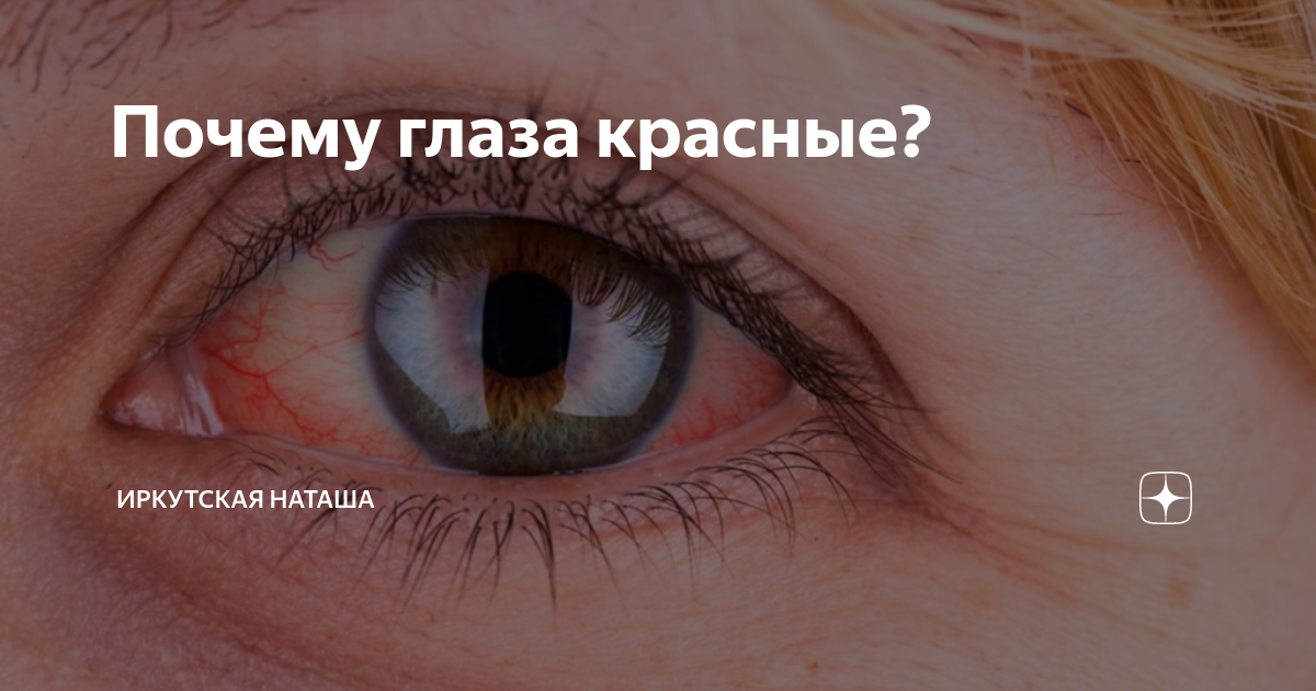 Почему глаза красные? | Иркутская Наташа | Дзен
