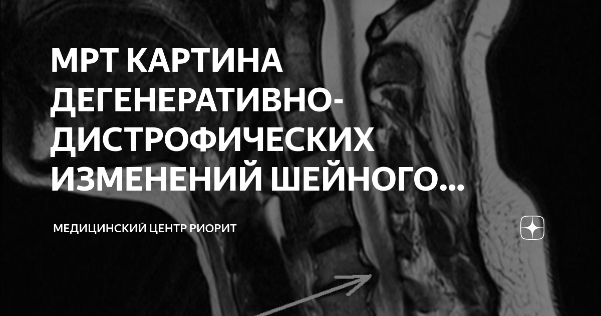 Выраженное дегенеративное изменения шейного. Дегенеративно-дистрофические изменения шейного отдела позвоночника. Дегенеративно-дистрофические изменения позвоночника что это. Дегенеративные изменения грудного отдела позвоночника