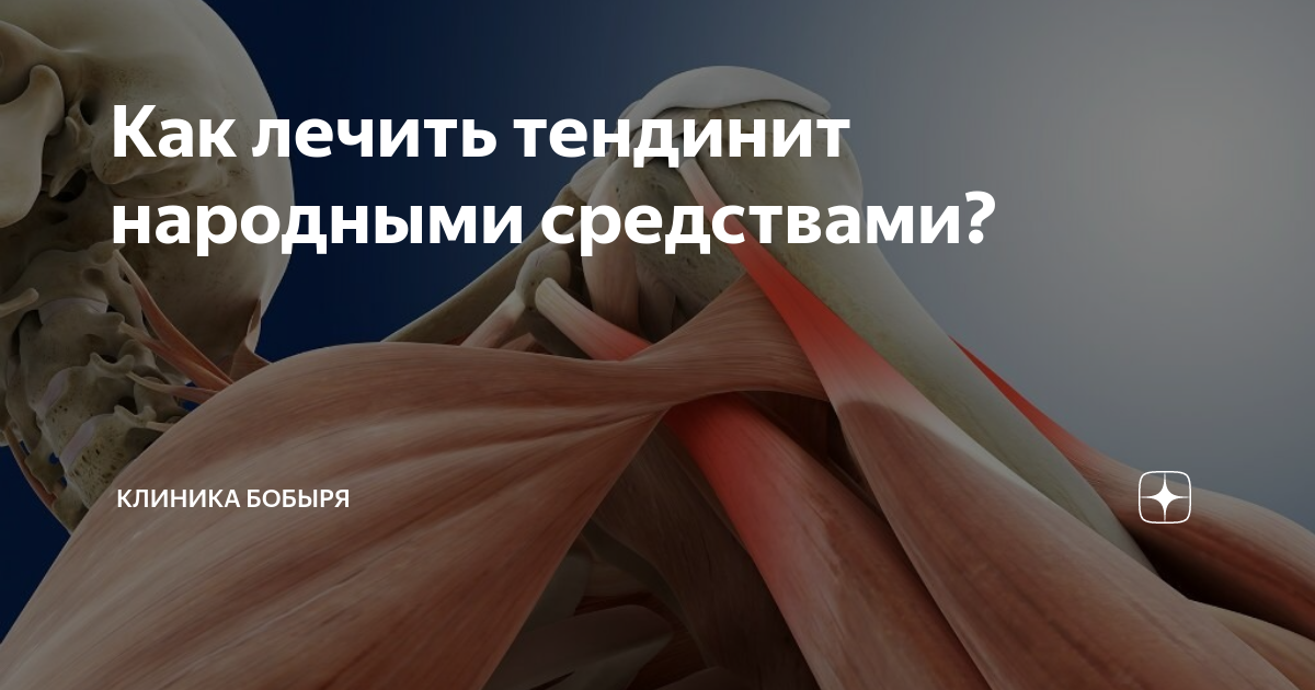 Способы лечения тендинита в домашних условиях народными средствами