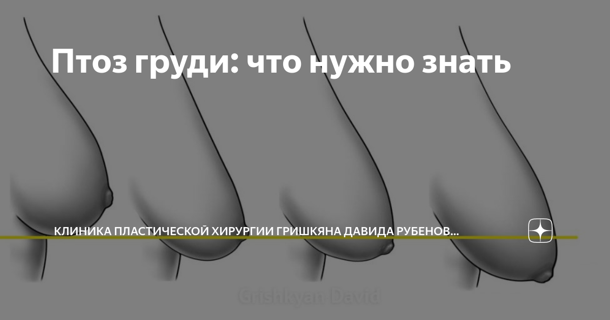 Опущение груди: лечение птоза грудных желез