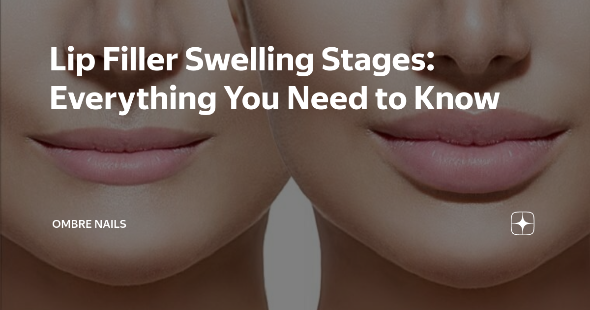 Lip Filler Swelling Stages: What Is Normal