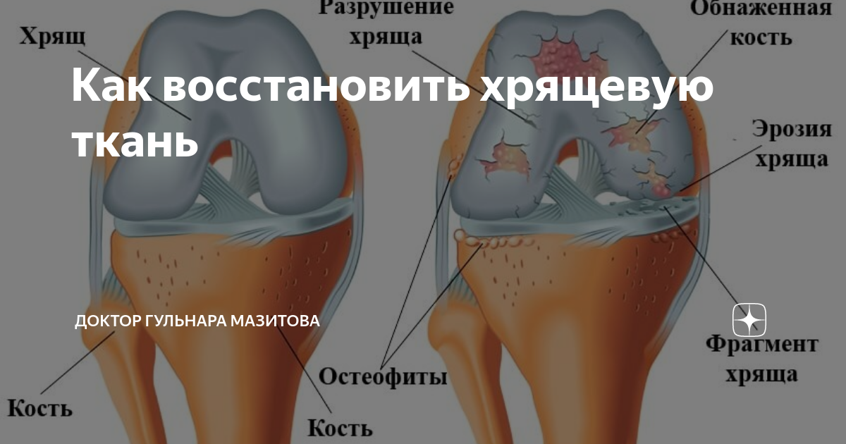 Что Нужно Есть Для Восстановления Хрящевой Ткани?