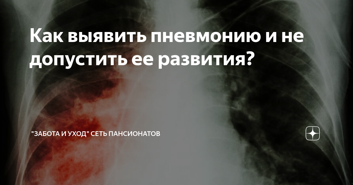 Что значит: лёгочный рисунок усилен за счёт сосудистого компонента — вопрос №1788274