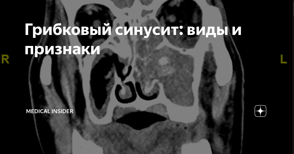 Грибок в пазухе носа симптомы. Мицетома гайморовой пазухи на кт. Мицетома гайморовой пазухи на кт. Мицетома гайморовой пазухи на кт. Мицетома верхнечелюстной пазухи мрт.