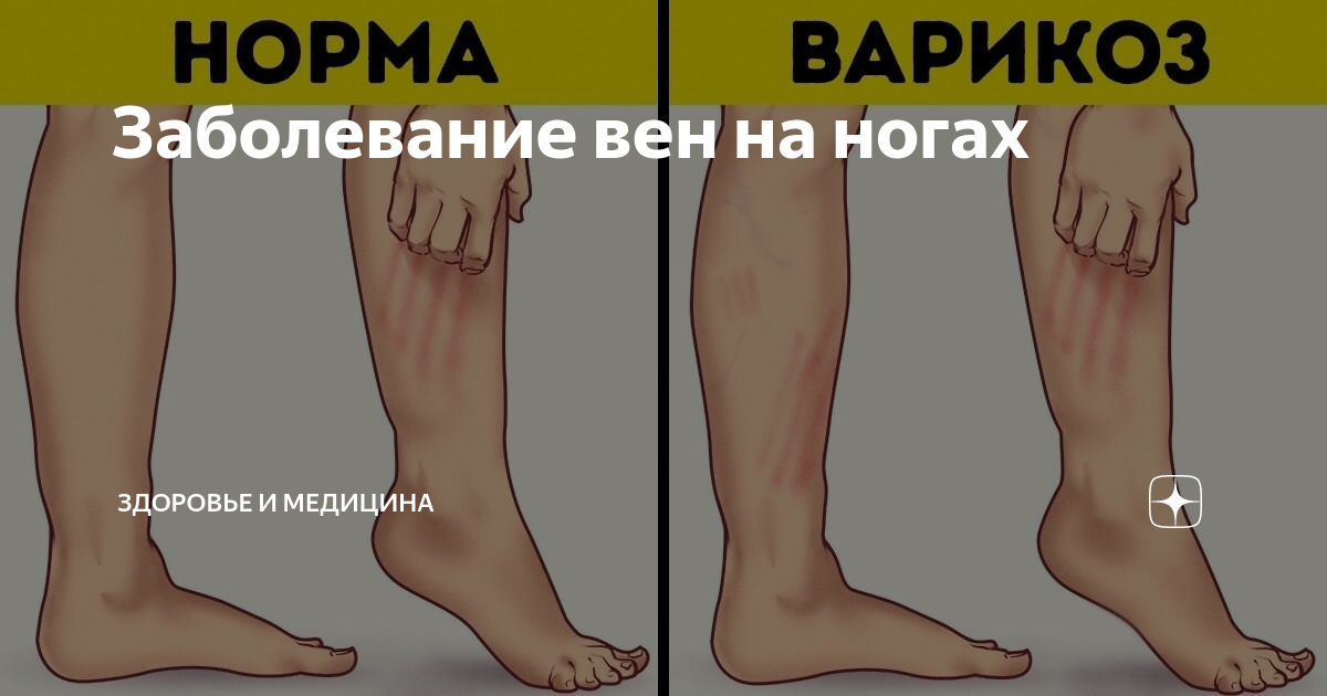 Заболевание вен на ногах | Здоровье и медицина | Дзен