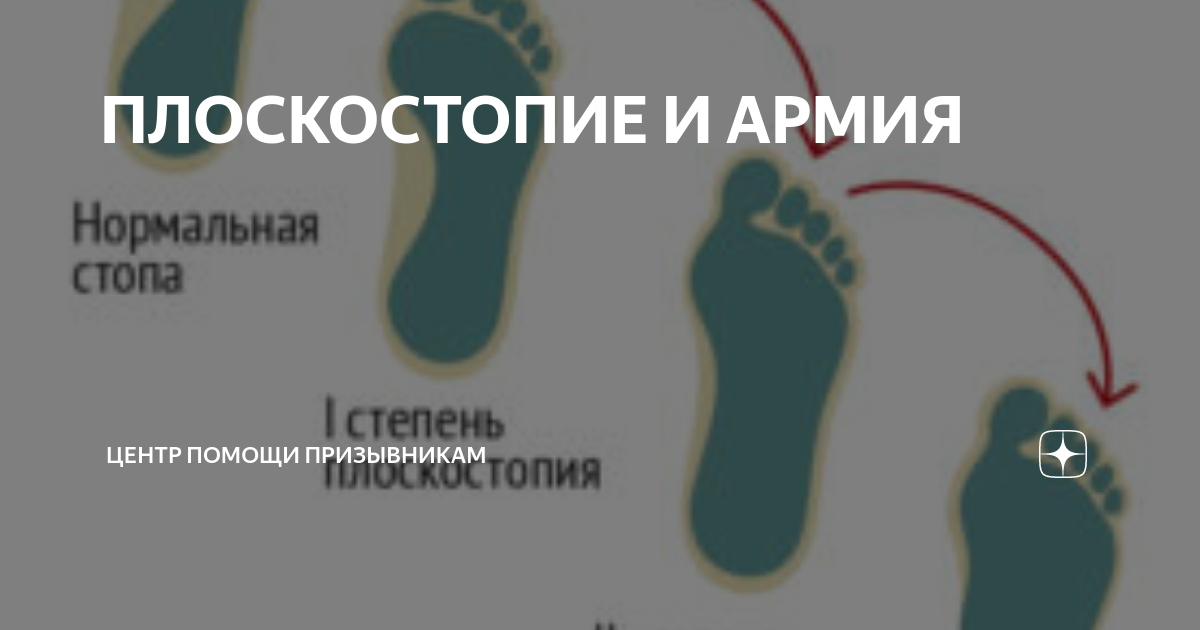 плоскостопие iii степени. плоскостопие какие войска. продольное плоскостопие 3 степени армия. продольно-поперечное плоскостопие градусы. двустороннее продольное плоскостопие.