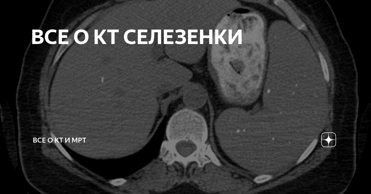 Кт картина спленомегалии