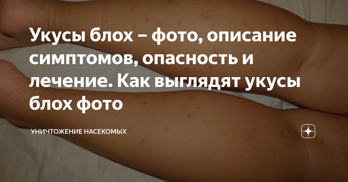 Укусы блох – фото, описание симптомов, опасность и лечение. Как ...