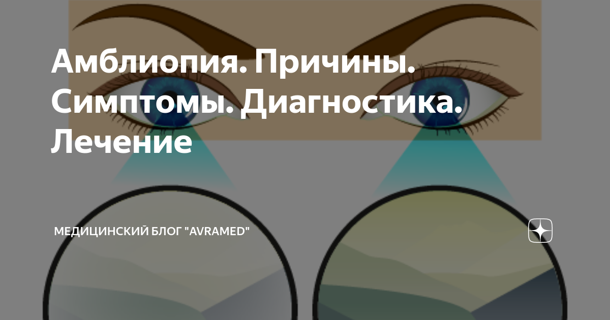 Амблиопия. Причины. Симптомы. Диагностика. Лечение | Медицинский блог ...