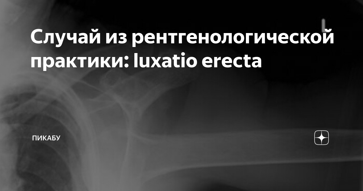 Случай из рентгенологической практики: luxatio erecta | Пикабу | Дзен