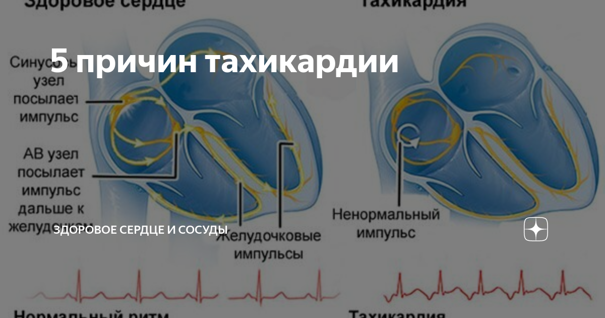 что значит тахикардия сердца