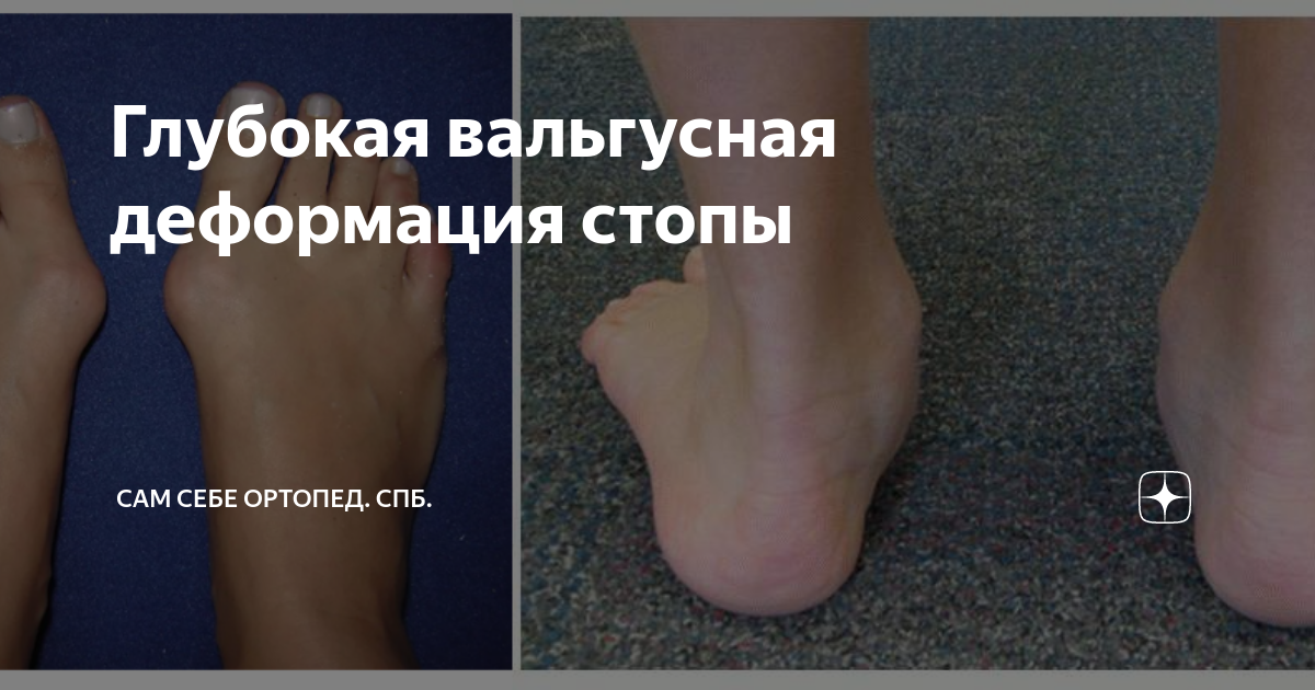 Глубокая вальгусная деформация стопы | Сам Себе Ортопед. Спб. | Дзен
