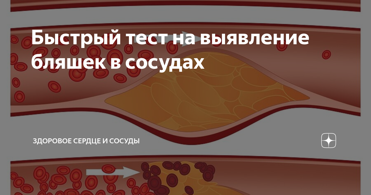 Клапаны в сосудах