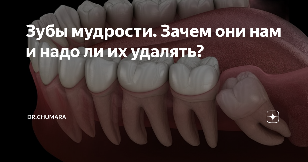 Зуб мудрости почему так назван. Зачем нужны зубы мудрости. Зуб мудрости почему так называется. Зубы мудрости зачем нужны удалять.