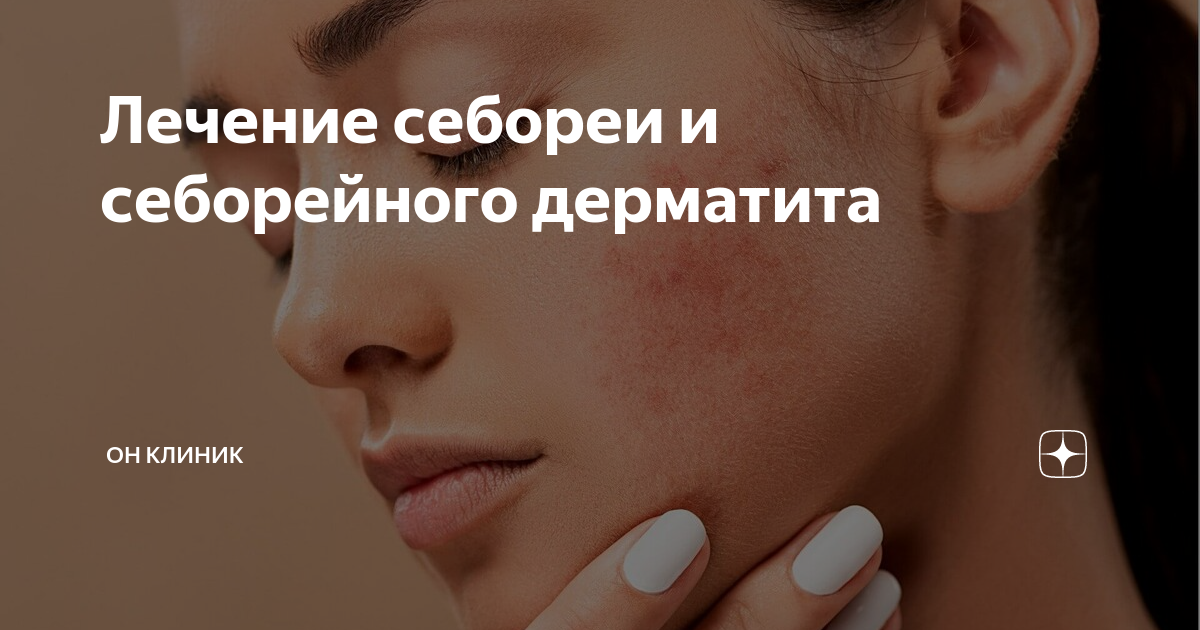 Лечение себореи и себорейного дерматита | Все о здоровье | Дзен
