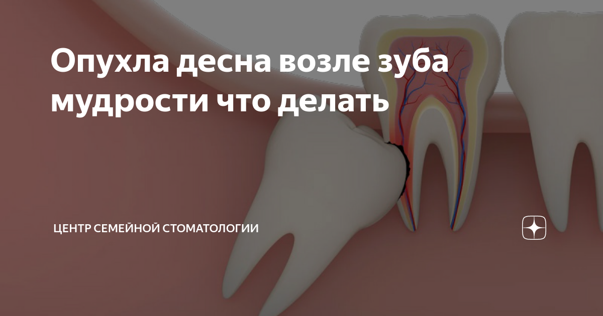 Как снять отек десны в домашних условиях Корневая киста зуба, Киста Зуба (Что Это Такое) Как Лечить 100% информации