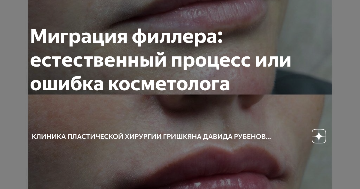 Миграция филлера: естественный процесс или ошибка косметолога ...