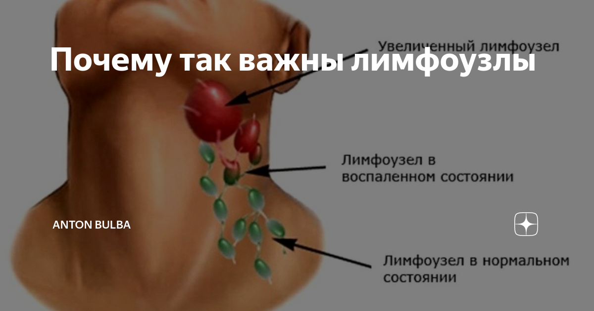 Болезненные лимфатические узлы. Лимфатические узлы на шее.