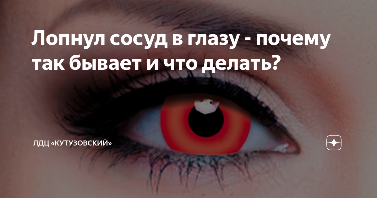 Лопнул капилляр в глазу какие капли можно