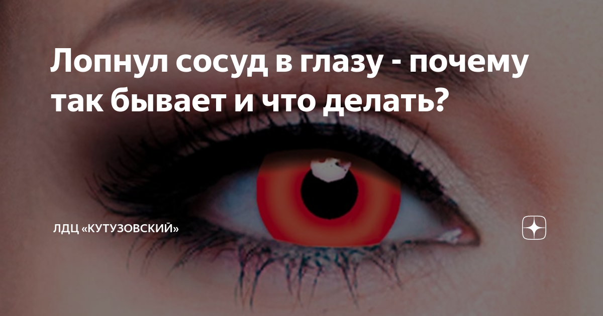 Что делать если лопнул сосуд в глазу? | Сеть офтальмологических центров Визиум