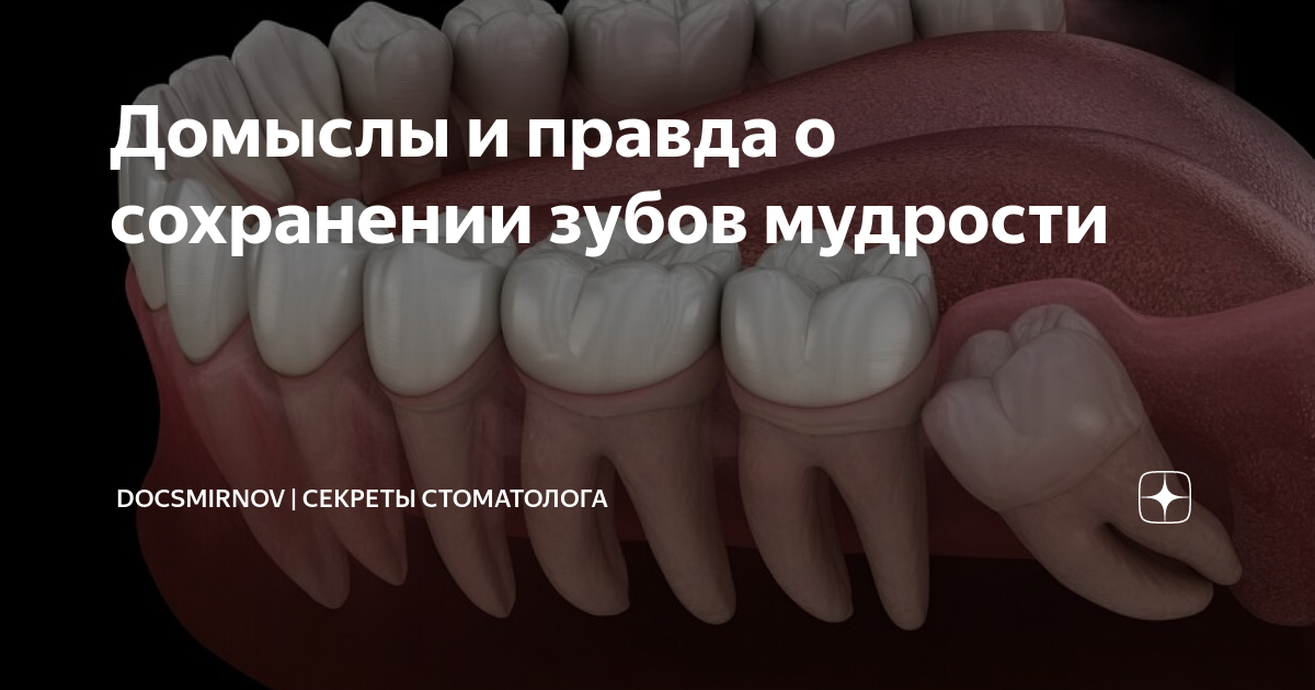 Зуб мудрости вырос сбоку. Неправильный рост зуба мудрости. Режется зуб мудрости и болит 6 и 7 зубы. Полуретинированный зуб мудрости. Зуб мудрости растет неправильно.