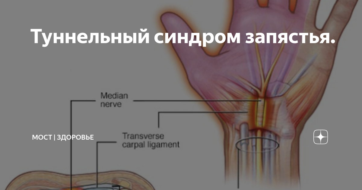 Локтевой туннельный синдром