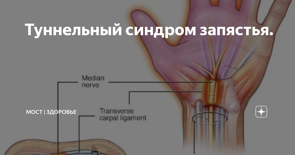 Картинки туннельный синдром