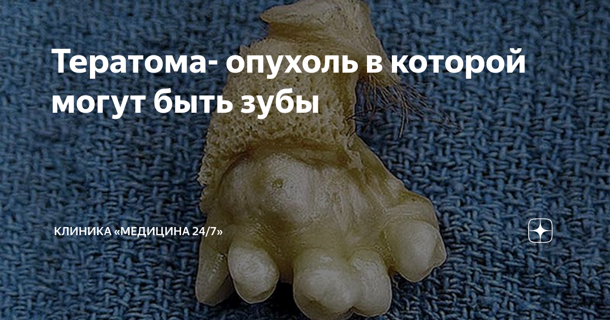 Тератома- опухоль в которой могут быть зубы | Международная клиника ...