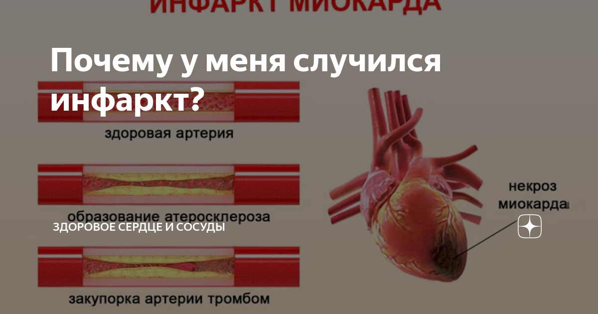 Стрессовый инфаркт