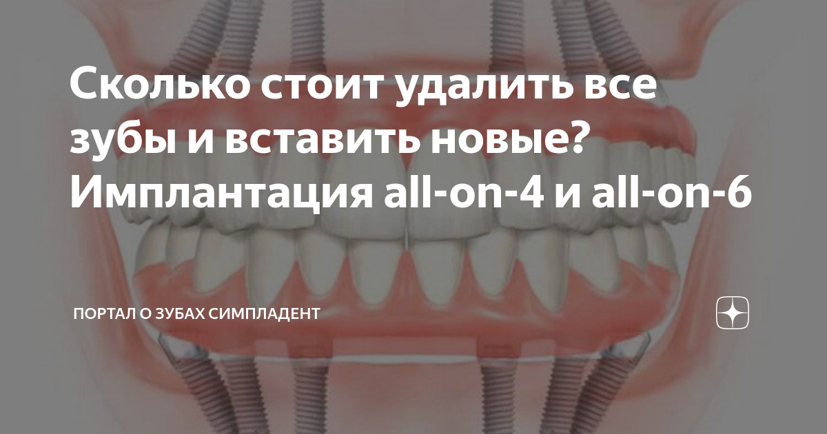 Сколько стоит удалить все зубы и вставить новые? Имплантация all-on-4 и ...