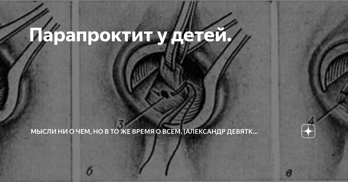 Как выглядит свищ после парапроктита Парапроктит у детей. Мысли ни о чем, но в то же время о всем. (Александр Девятки