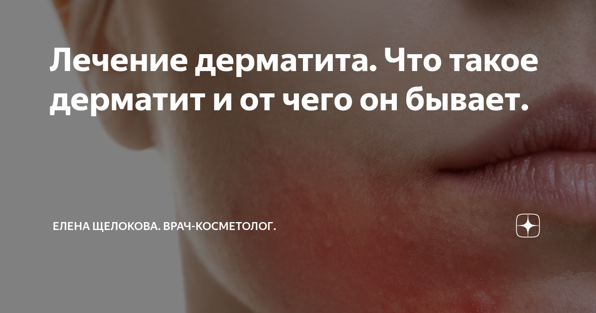 Лечение дерматита отзывы