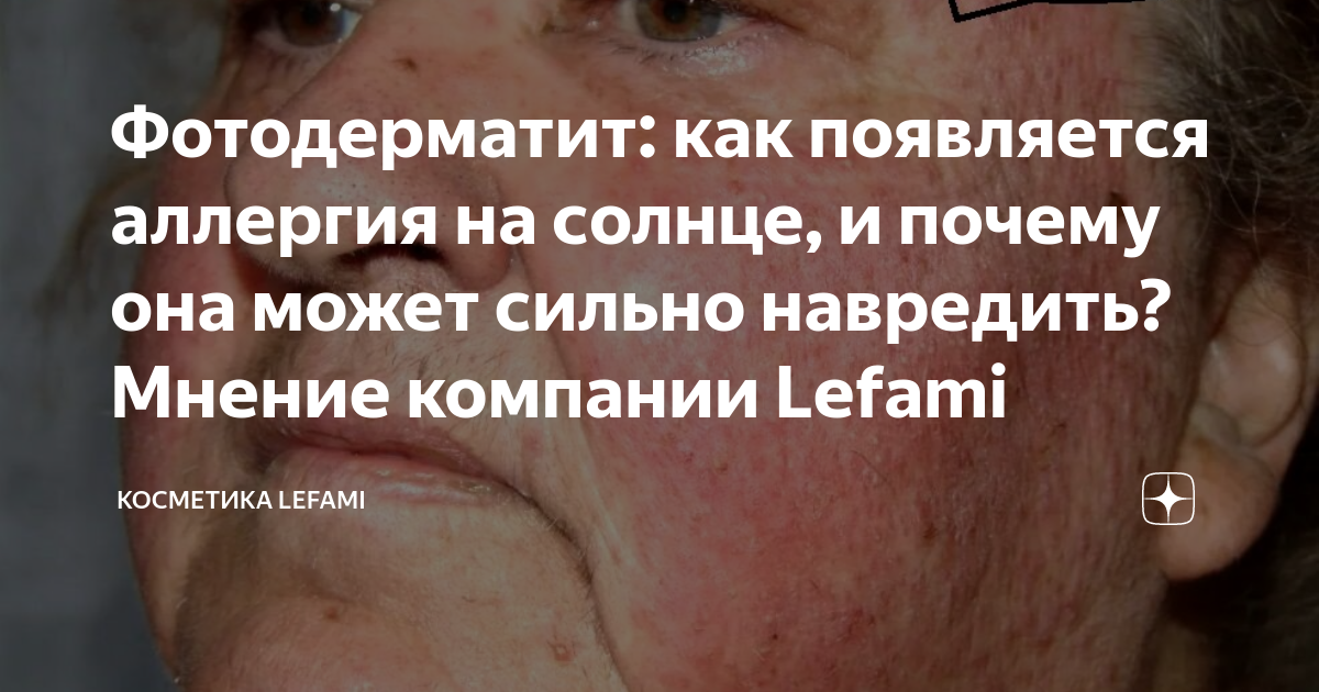 Аллергия на солнце: что это такое, как выглядит и как ее лечить