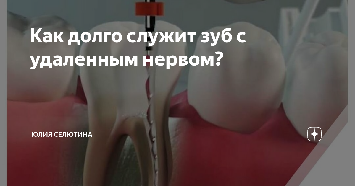 Как долго служит зуб с удаленным нервом? | Юлия Селютина | Дзен