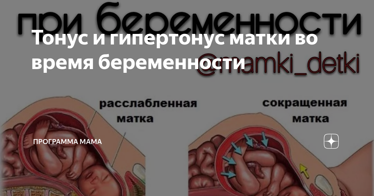 Гипертонус матки 1 триместр. Если тонус матки как убрать. Тонус матки можно снять розой коленно локтевой?.