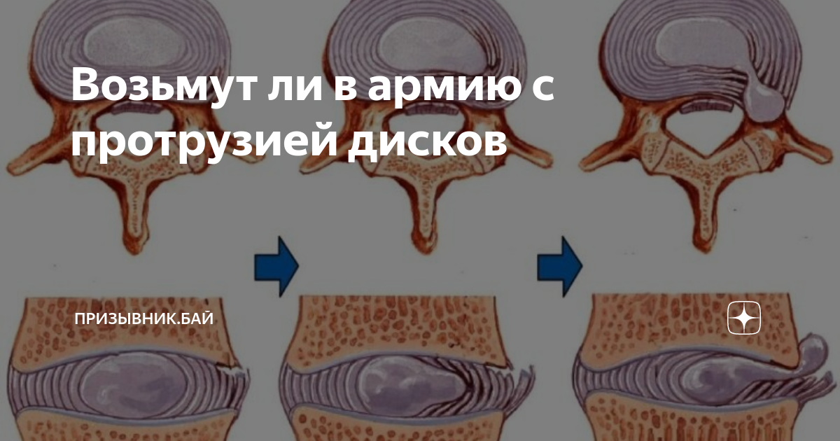 Берут ли в армию с протрузией?