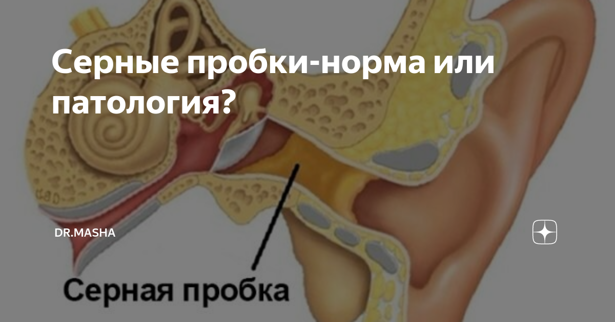 Серная пробка у ребенка: удаление серной пробки в Москве - клиника Фэнтези