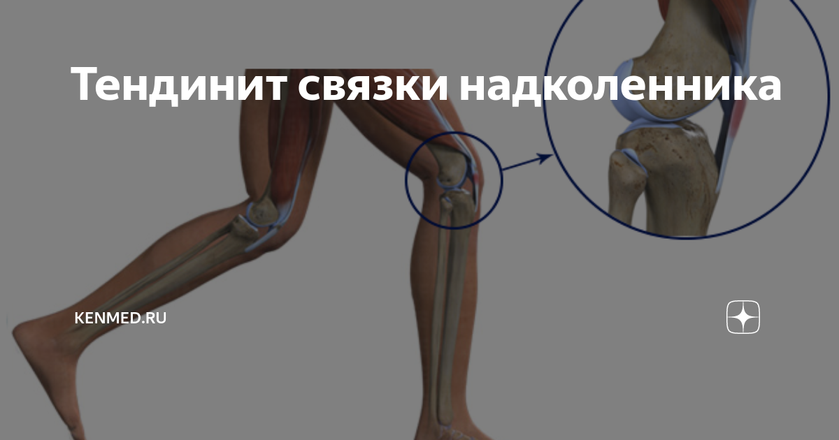 Тендинит коленного сустава: дорогостоящего лечения можно избежать