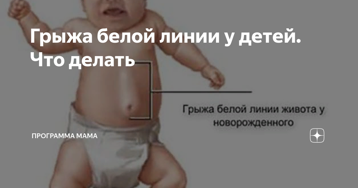 Грыжа белой линии живота у ребенка: основные аспекты, рекомендации врачей и мето
