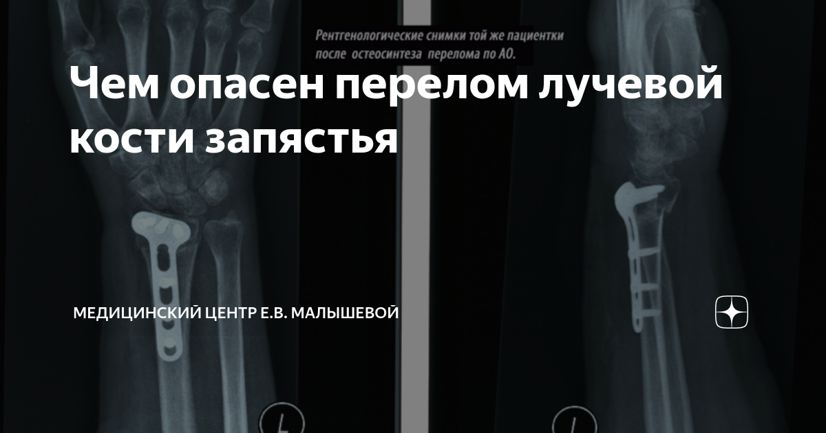 Отзывы после перелома лучевой кости. Отзывы после перелома лучевой кости