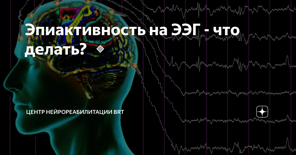 эпистатус ээг. эпиактивность что это. вертексные потенциалы на ээг. как выглядит эпиактивность на графике. абсансная эпилепсия на ээг.
